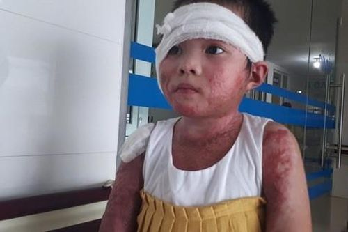 Sức khỏe của cô bé 8 tuổi bị bỏng cồn cả người thoát chết kỳ diệu hiện ra sao?