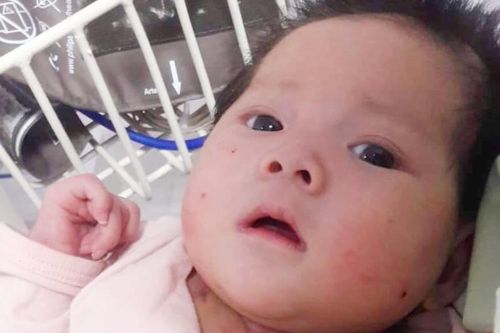Xót xa bé gái bị bệnh tim, teo não không có tiền phẫu thuật