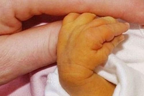 Gia đình chủ quan, bé 7 ngày tuổi phải thay máu