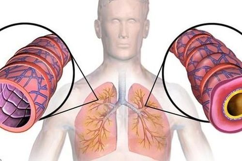 Người có tiền sử bị hen phế quản tái phát khi giao mùa cần làm ngay những điều này để phòng bệnh