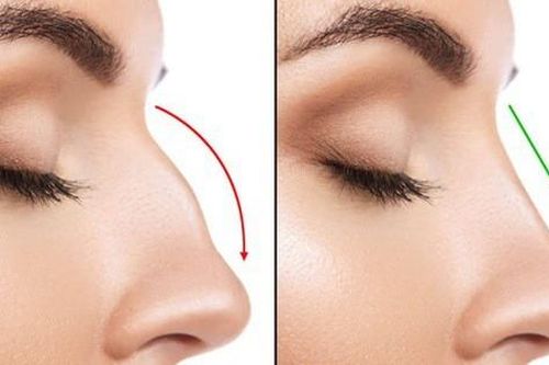 Tiêm chất làm đầy để nâng mũi, vừa kết thúc thủ thuật cô gái 19 tuổi lập tức bị mù 1 bên mắt