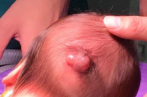 Bé trai vừa sinh ra đã có khối u sau đầu
