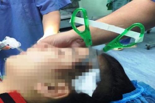 Hãi hùng bé gái 10 tuổi bị kéo đâm thủng sọ