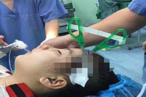 Bé 10 tuổi bị bạn dùng kéo đâm vào thái dương