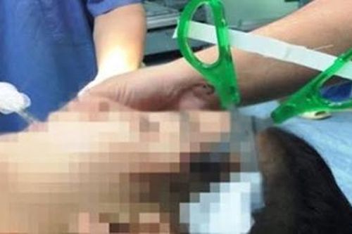 Bé gái bị bạn dùng kéo đâm xuyên hộp sọ