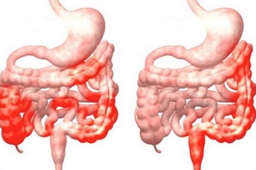 Nhiễm khuẩn tiêu hóa có thể gây ra bệnh lý nguy hiểm