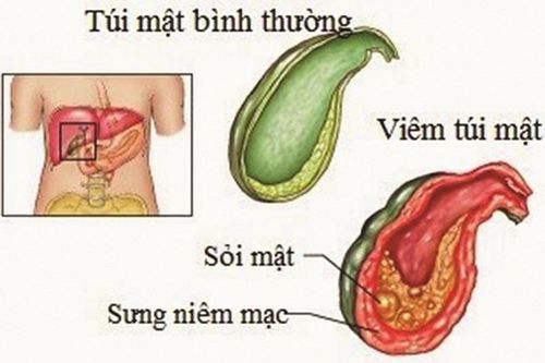 Nguyên nhân bé 9 tuổi đã bị sỏi mật khiến bố mẹ hết hồn