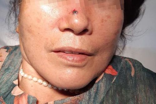 Nốt ruồi 2 năm trên mũi lại 'hóa' ung thư da nguy hiểm