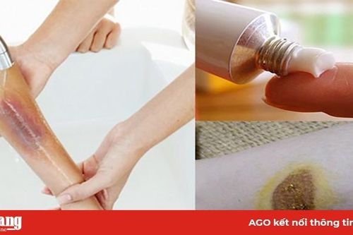 Xử lý để tránh sẹo phỏng bô xe máy