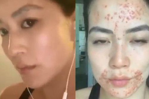 Từ một cô gái có làn da trắng mịn hồng hào, nữ phóng viên mắc chứng bệnh với mụn nổi khắp miệng ai cũng phát sợ