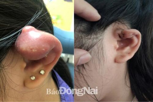 Cẩn trọng khi xỏ khuyên tai