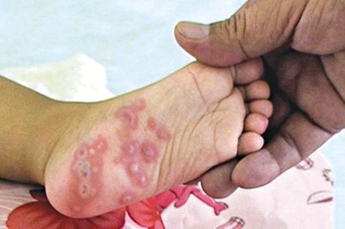 Tích cực phòng, chống bệnh tay chân miệng