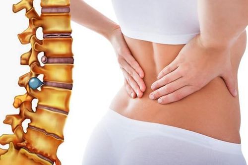 2 điểm ít biết về phương pháp chữa thoát vị đĩa đệm nhanh và hiệu quả