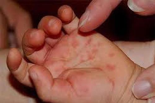 Thuốc chống virus 'chữa khỏi' bệnh tay chân miệng?