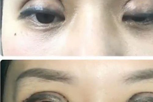 Biến chứng cắt mí ở spa, cô gái đi ngủ không nhắm được mắt