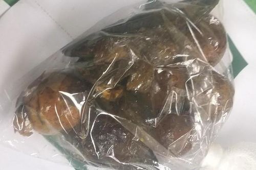 Mổ dạ dày cứu người đàn ông nuốt cả đồng xu, hạt xoài, quả chanh leo... vào bụng