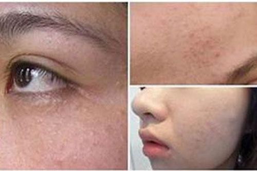 Điểm qua những cách trị mụn trong dân gian có thể bạn chưa biết