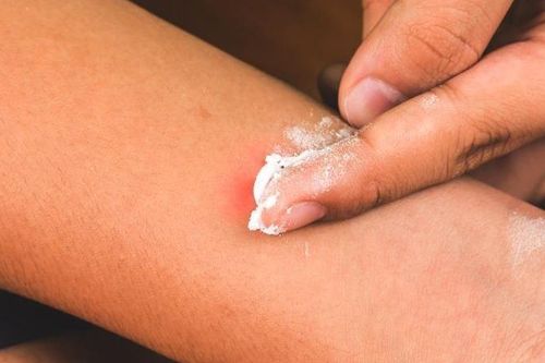 Nhận biết và xử lý tổn thương do độc tố từ kiến ba khoang