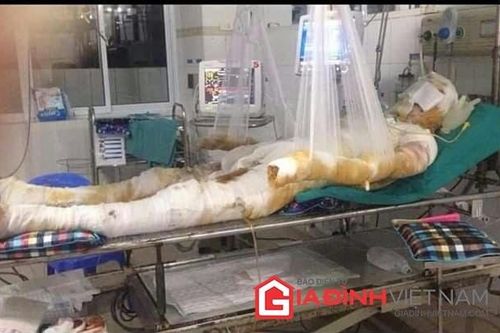 Tai nạn bất ngờ, 20 ngày điều trị dốc túi nộp viện phí 800 triệu đồng
