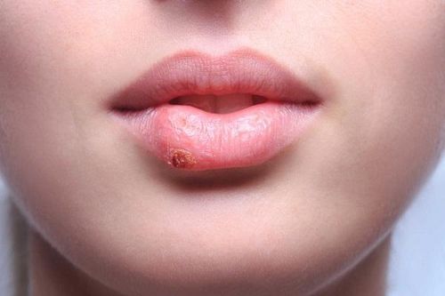 7 dấu hiệu trên môi cứ xuất hiện là cảnh báo bệnh nguy hiểm