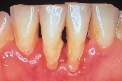 Người phụ nữ sảy thai 4 lần trong 3 năm vì căn bệnh ai cũng biết nhưng không phòng tránh