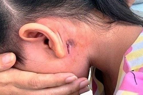 Liên tiếp 2 ca nhiễm vi khuẩn Whitmore được phát hiện ở Bình Định