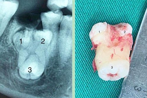 Bệnh viện Đa khoa tỉnh: Điều trị trường hợp răng sinh ba ngầm hiếm gặp