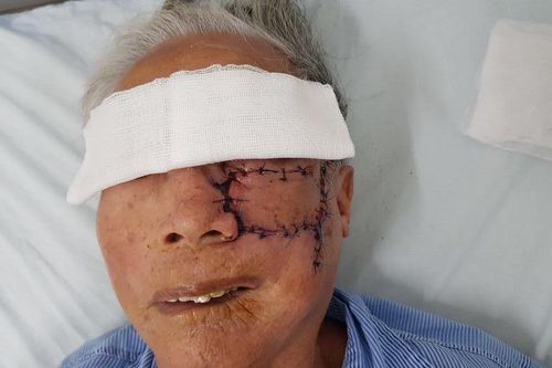 Cắt khối u sùi loét, tạo hình thành công má trái cho cụ ông 91 tuổi
