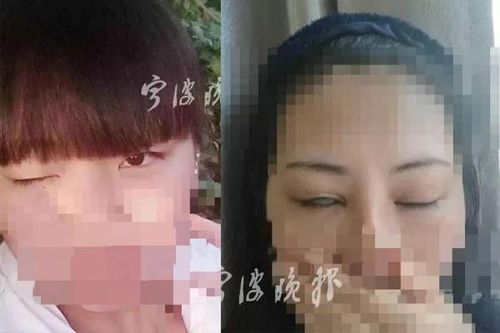 Mất 100 triệu đồng cắt mí, cô gái 20 tuổi không thể nhắm mắt khi ngủ