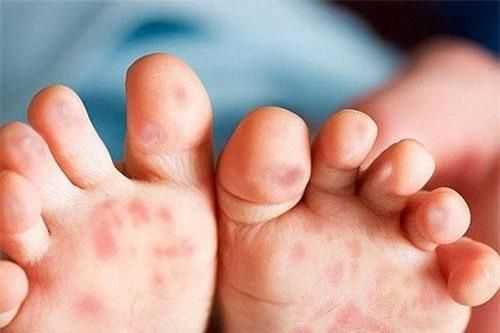Bệnh tay chân miệng khó phát hiện, dễ bị nhầm với một số bệnh khác
