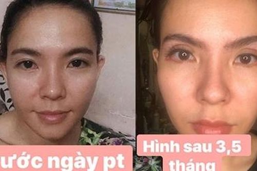 Hỏng mí mắt vì quá tin thẩm mỹ viện mang danh Quốc tế