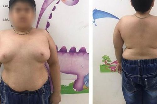 Nhầm lẫn với béo phì, nhiều cha mẹ không ngờ con mắc hội chứng Cushing nguy hiểm