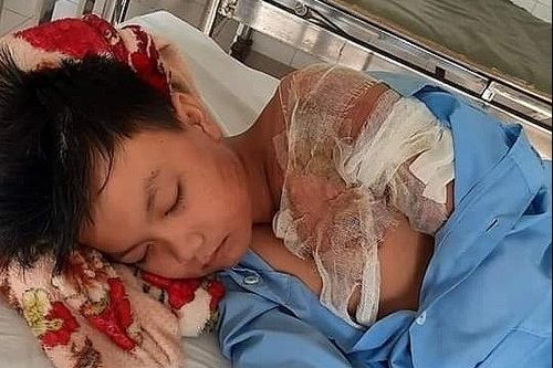 Long An: Cha tạt nước sôi khiến con ruột bị bỏng