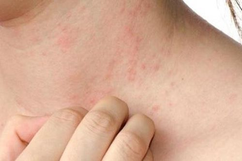Khổ sở vì mẩn ngứa cả đêm do bệnh viêm da cơ địa