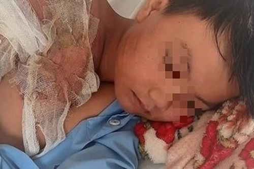 Cháu bé 11 tuổi bị cha ruột tạt nước sôi vào người gây bỏng nặng