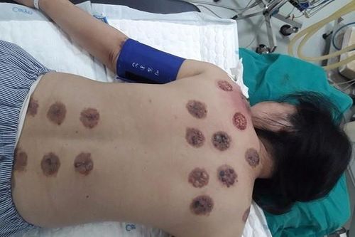 Rùng mình người phụ nữ bị viêm loét, hoại tử da lưng vì đi giác hơi