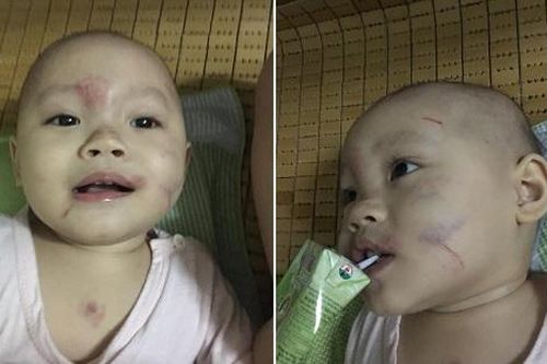 Bé trai bị xây xát, bầm tím cơ thể trong ngày đầu đi học