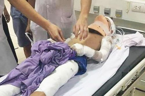 Quét dọn trên tầng thượng, bé trai 12 tuổi bị phóng điện phải tháo hai cánh tay