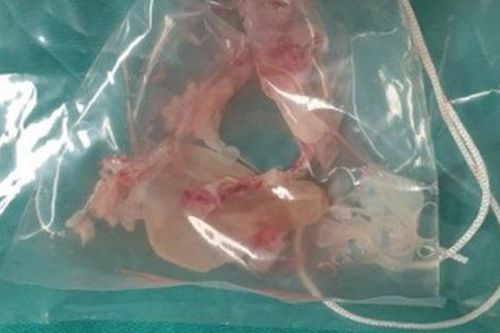Ổ sán 'trú ẩn' trong não khiến người đàn ông giảm trí nhớ