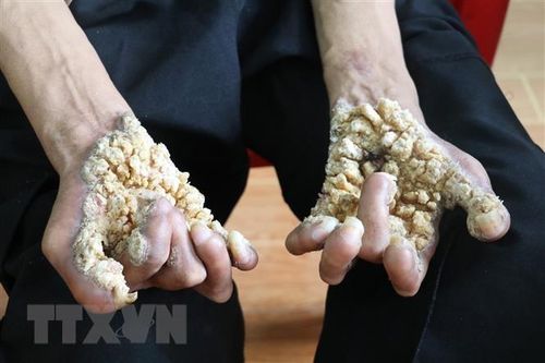 Ghi nhận trường hợp 'người cây' đầu tiên tại Việt Nam