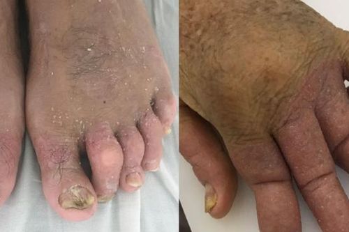 Uống thuốc nam chữa vẩy nến, nào ngờ 'tiền mất tật mang' khớp biến dạng