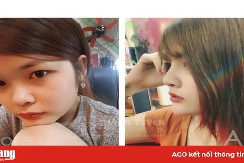Những điều cần biết khi nâng mũi
