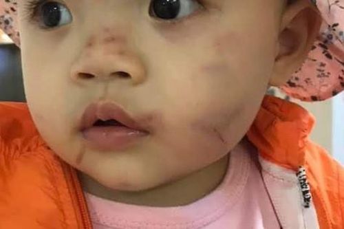 Hải Phòng: Đã có kết luận vụ cháu bé 14 tháng tuổi nghi bị bạo hành ngay trong ngày đầu đi học