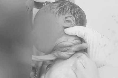 Bé trai chào đời với 3 vòng dây rốn quấn cổ