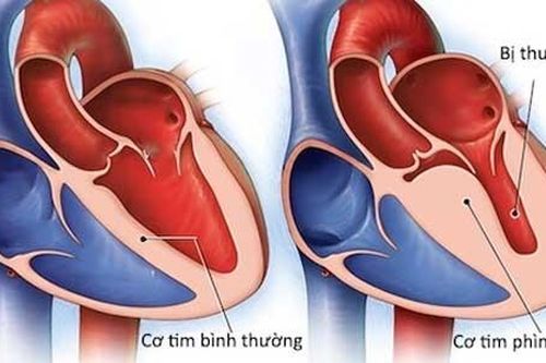Viêm cơ tim: Dấu hiệu nào cảnh báo nguy hiểm?
