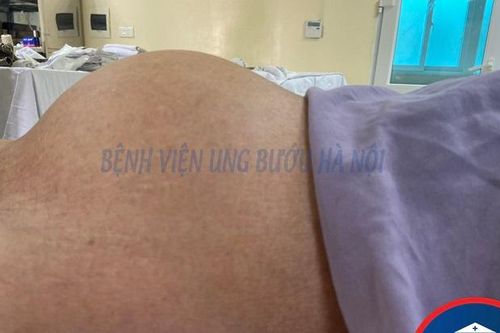 Cụ bà 80 tuổi thoát khỏi khối u buồng trứng nặng hơn 3kg