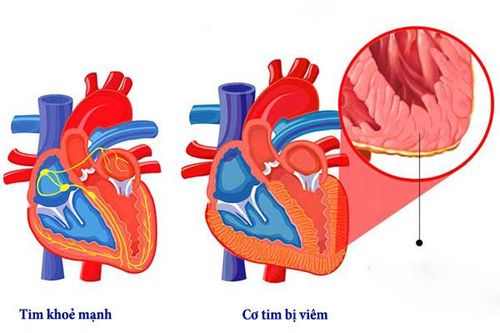 Bệnh viêm cơ tim có phòng được không?