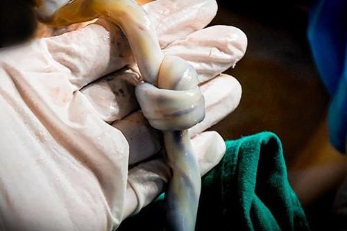 Mẹ con sản phụ bị thắt nút dây rốn hiếm gặp