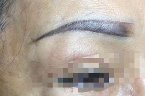 Người phụ nữ hôn mê sau khi xăm chân mày đã tử vong
