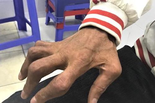Biến dạng khớp vì điều trị vảy nến bằng thuốc trôi nổi